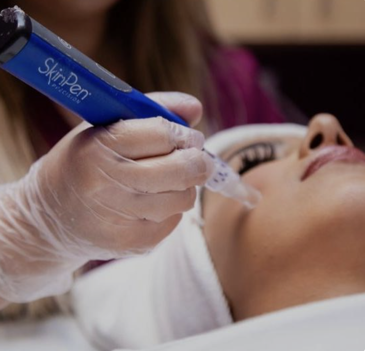 SkinPen Microneedling Treatment at True Medical Spa